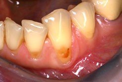 Rezessionsdeckung: ästhetische Abdeckung freiliegender Zahnhälse mittels Schleimhautplastiken und Bindegewebstransplantaten