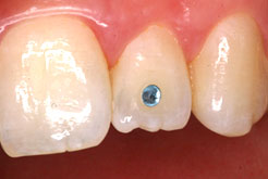 Zahnschmuck (dental jewels)