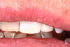 Zahnstellungskorrekturen oder Lückenschluss mit Veneers oder Komposit