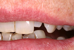 Zahnstellungskorrekturen oder Lückenschluss mit Veneers oder Komposit